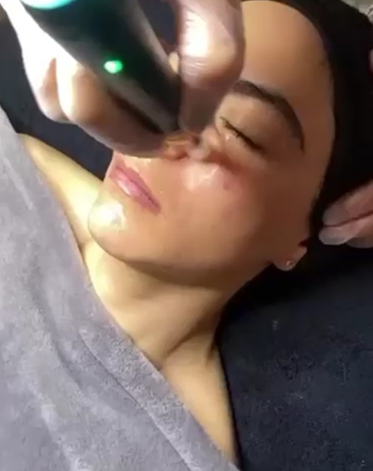 Micro Needle Leke Protokolü