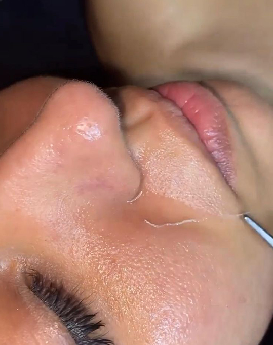 Colagen İp Protokolü